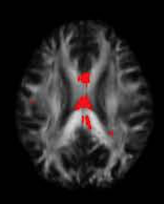 Sample MRI-DTI fractional anisotropy analysis 1