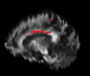 Sample MRI-DTI fractional anisotropy analysis 2