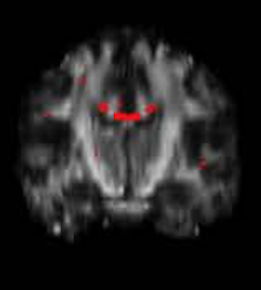 Sample MRI-DTI fractional anisotropy analysis 3
