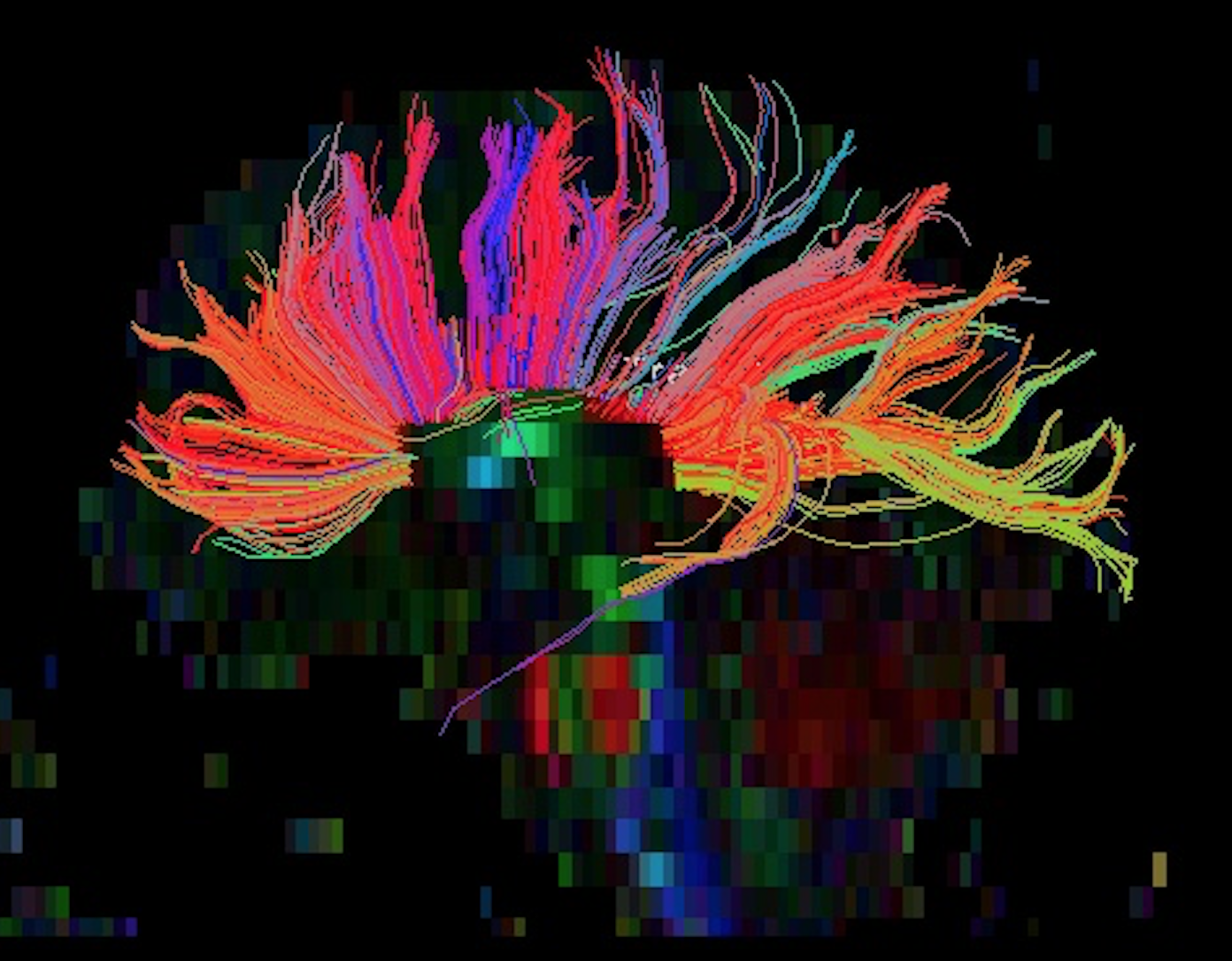 Sample MRI-DTI tractography analysis 4
