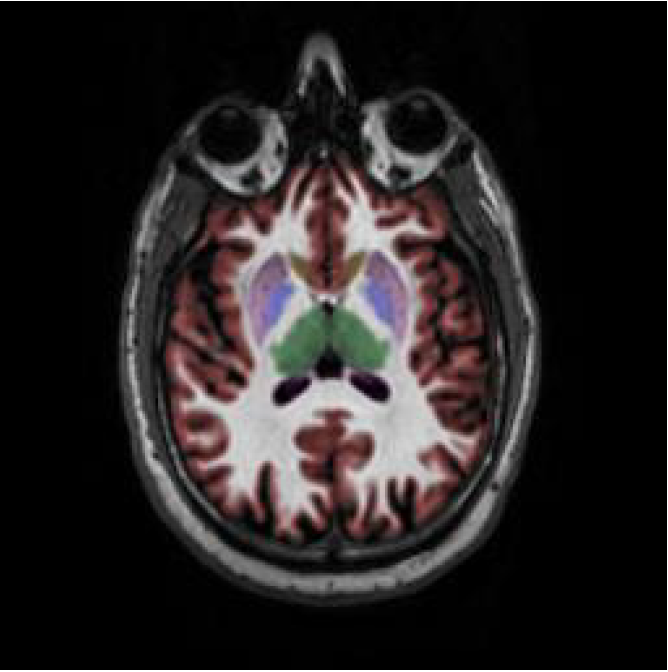 Sample MRI quantitative volumetric analysis 1