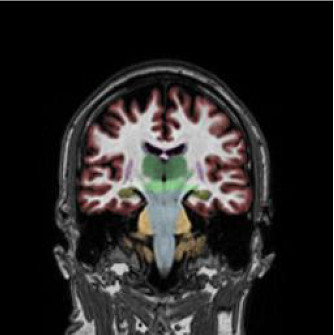 Sample MRI quantitative volumetric analysis 2