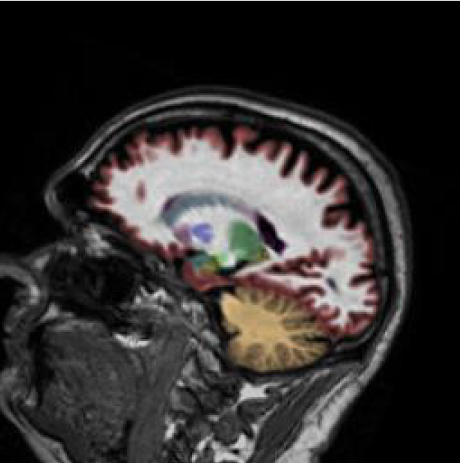 Sample MRI quantitative volumetric analysis 3